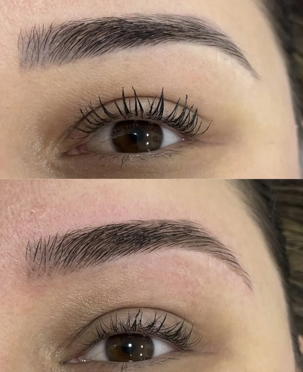 Antes e depois de remoção a laser de micropigmentação de sobrancelha