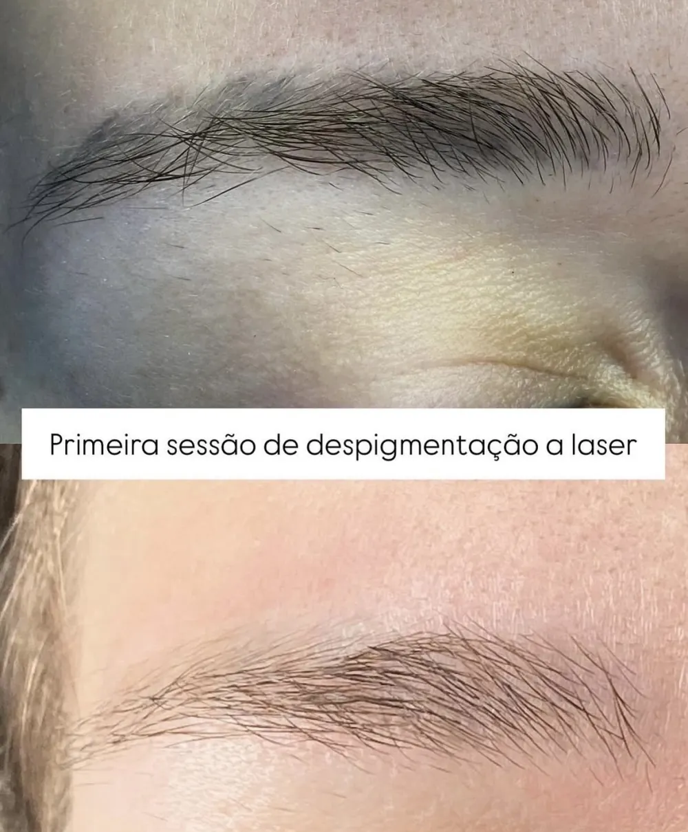 Antes e depois de remoção a laser de micropigmentação de sobrancelha