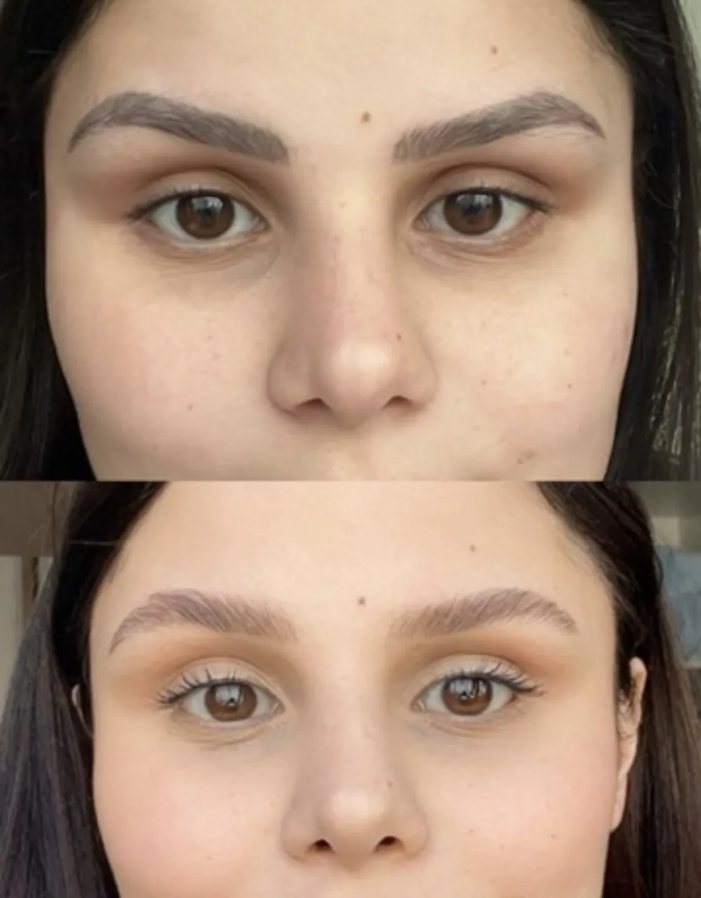 Antes e depois de remoção a laser de micropigmentação de sobrancelha