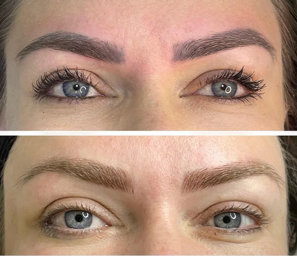 Antes e depois de remoção a laser de micropigmentação das duas sobrancelhas