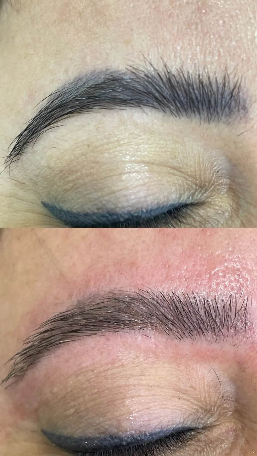 Antes e depois de remoção a laser de micropigmentação de sobrancelha escurecida